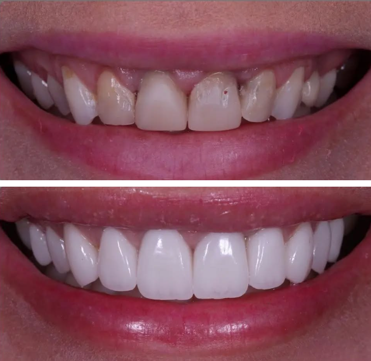 Hollywood Smile — Aladin Dental Clinic
