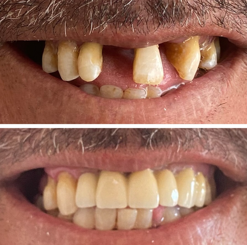 Pack 8 Couronnes — Aladin Dental Clinic