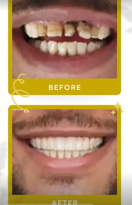 Pack 8 Couronnes — Aladin Dental Clinic