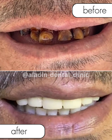 Hollywood Smile — Aladin Dental Clinic