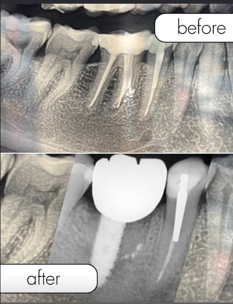 Implants Dentaires — Aladin Dental Clinic