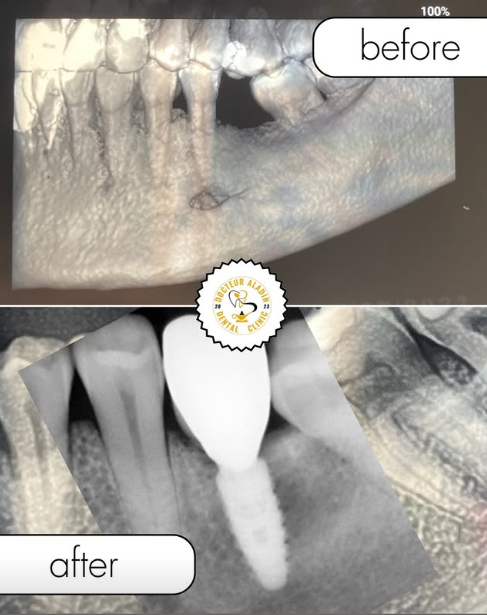 Implants Dentaires — Aladin Dental Clinic