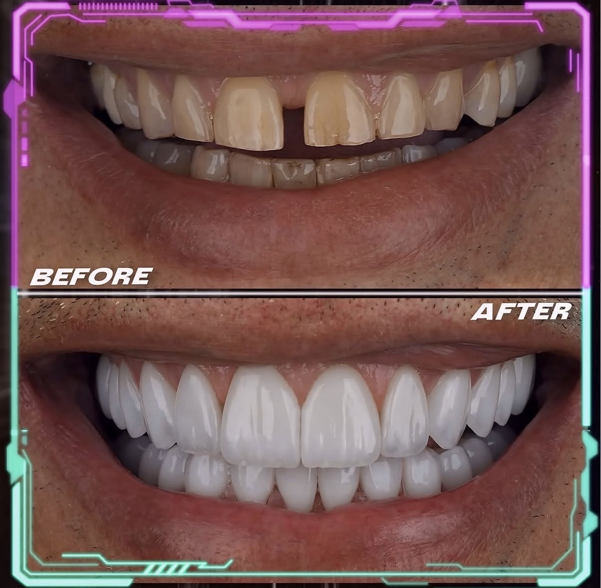 Couronnes Dentaires — Cronos Dental & Medical Clinic