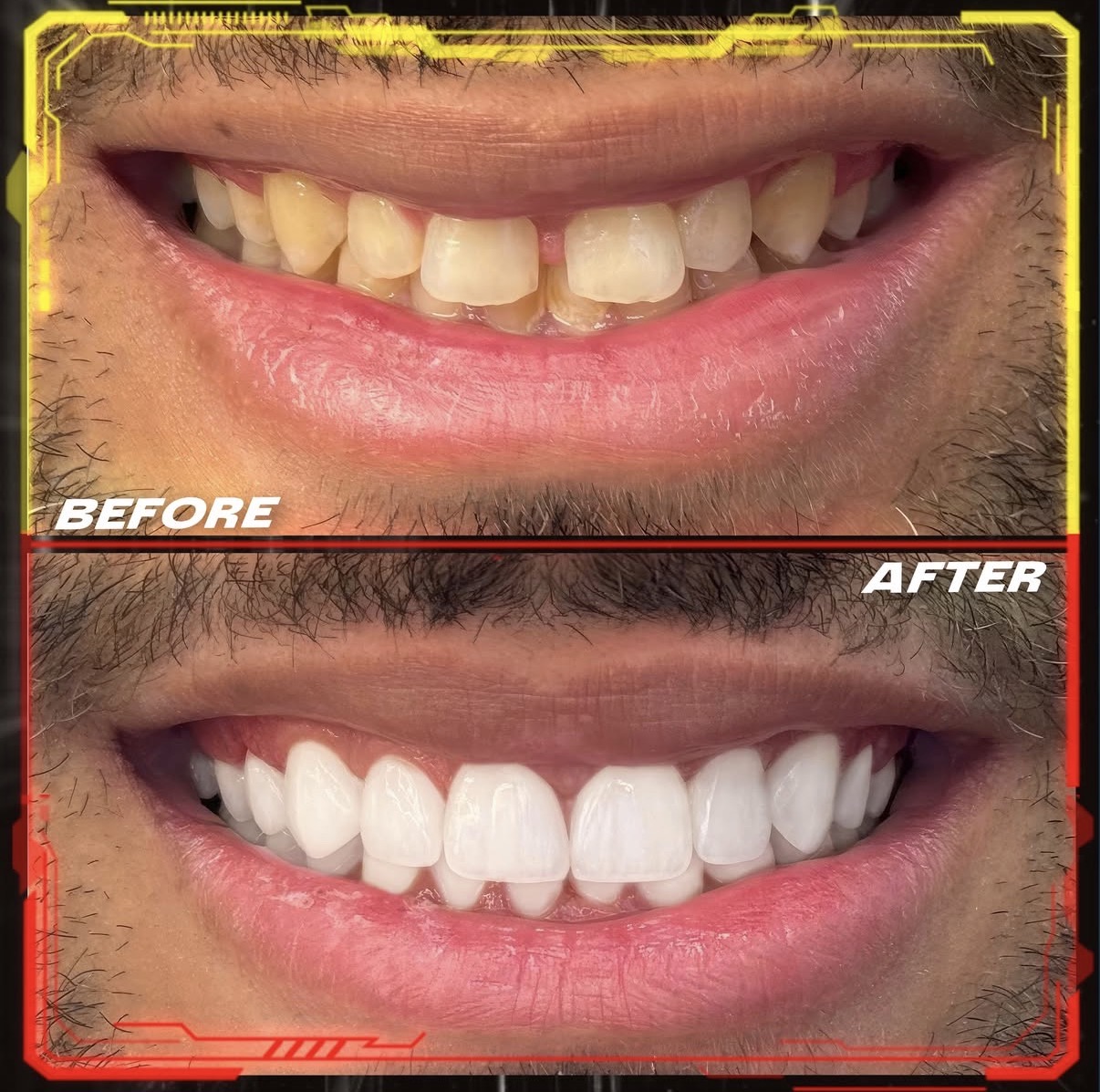 Couronnes Dentaires — Cronos Dental & Medical Clinic