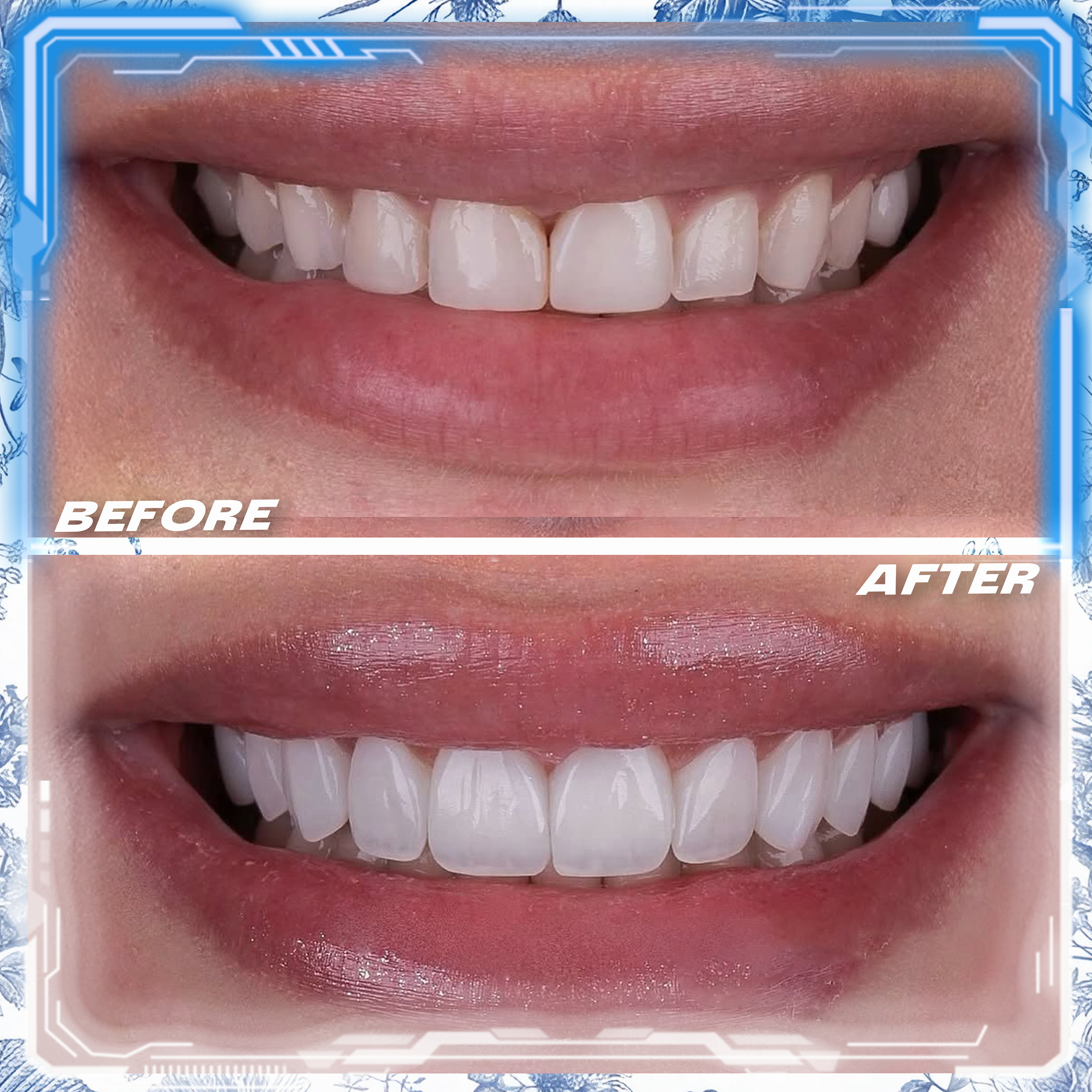 Couronnes Dentaires — Cronos Dental & Medical Clinic