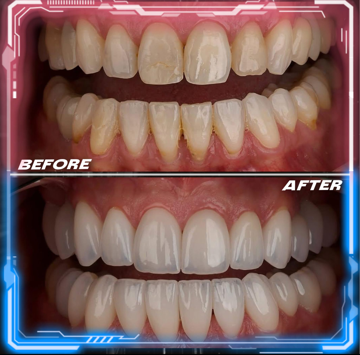 Couronnes Dentaires — Cronos Dental & Medical Clinic