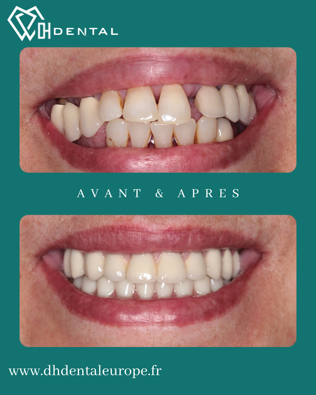All-On-4 — DH Dental