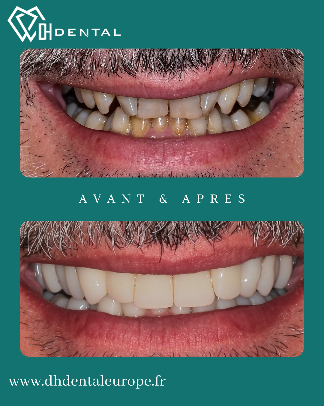 Couronnes Zircones — DH Dental