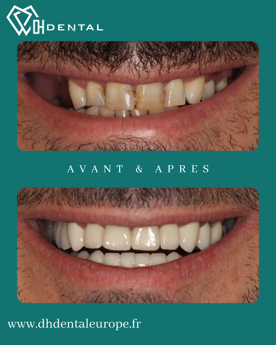 Couronnes Zircones — DH Dental