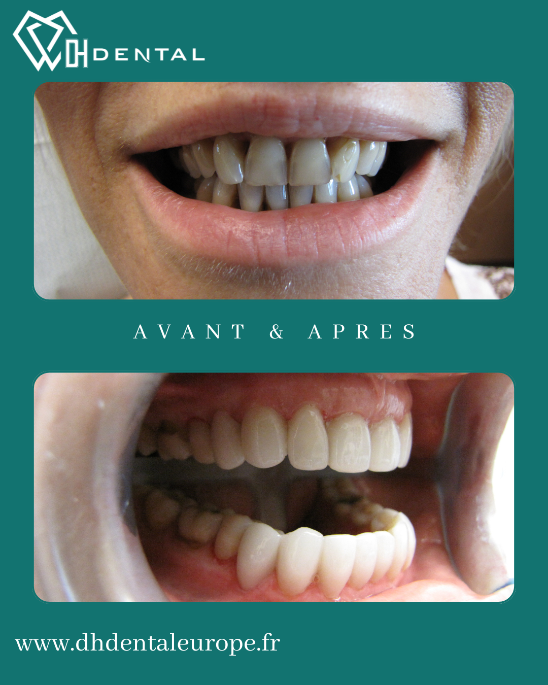 Facettes Dentaires — DH Dental
