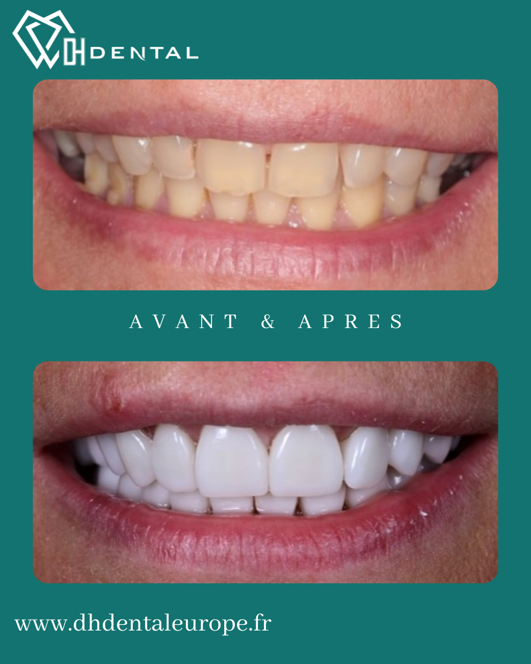 Facettes Dentaires — DH Dental