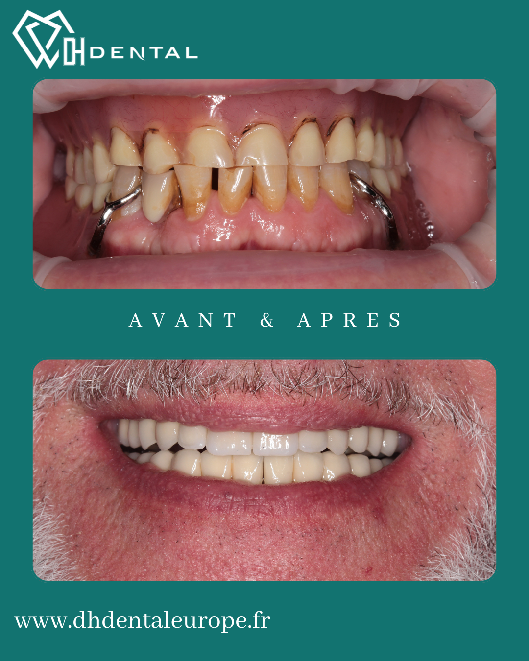 Implants Dentaires — DH Dental
