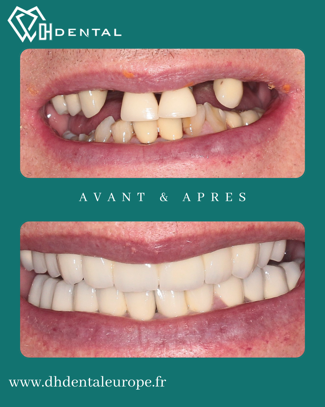Implants Dentaires — DH Dental
