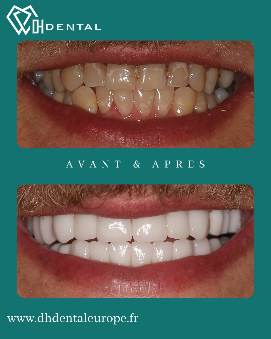 Hollywood Smile — DH Dental