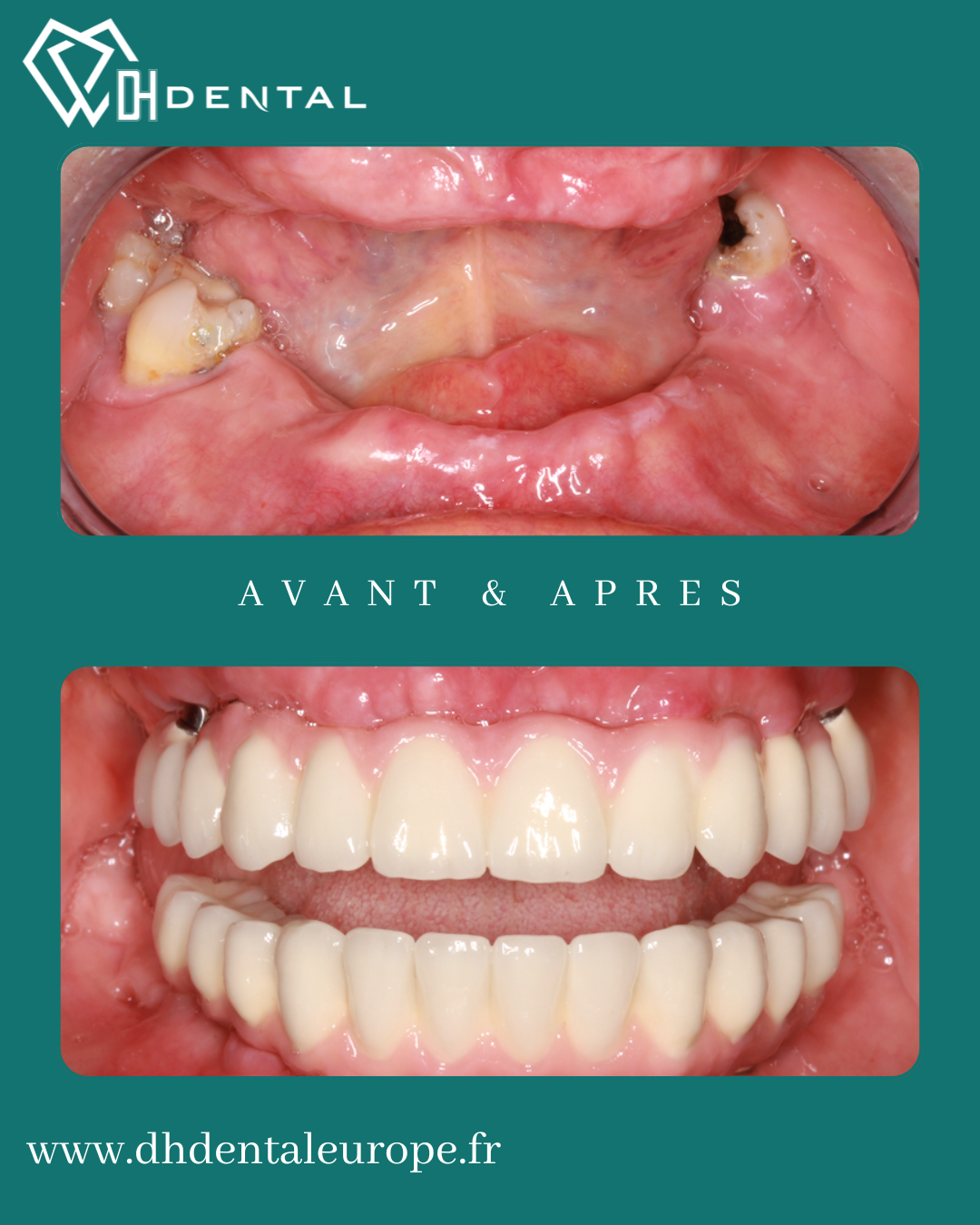 Reconstruction Totale — DH Dental