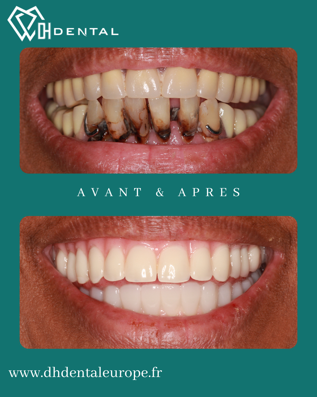 All-On-4 — DH Dental