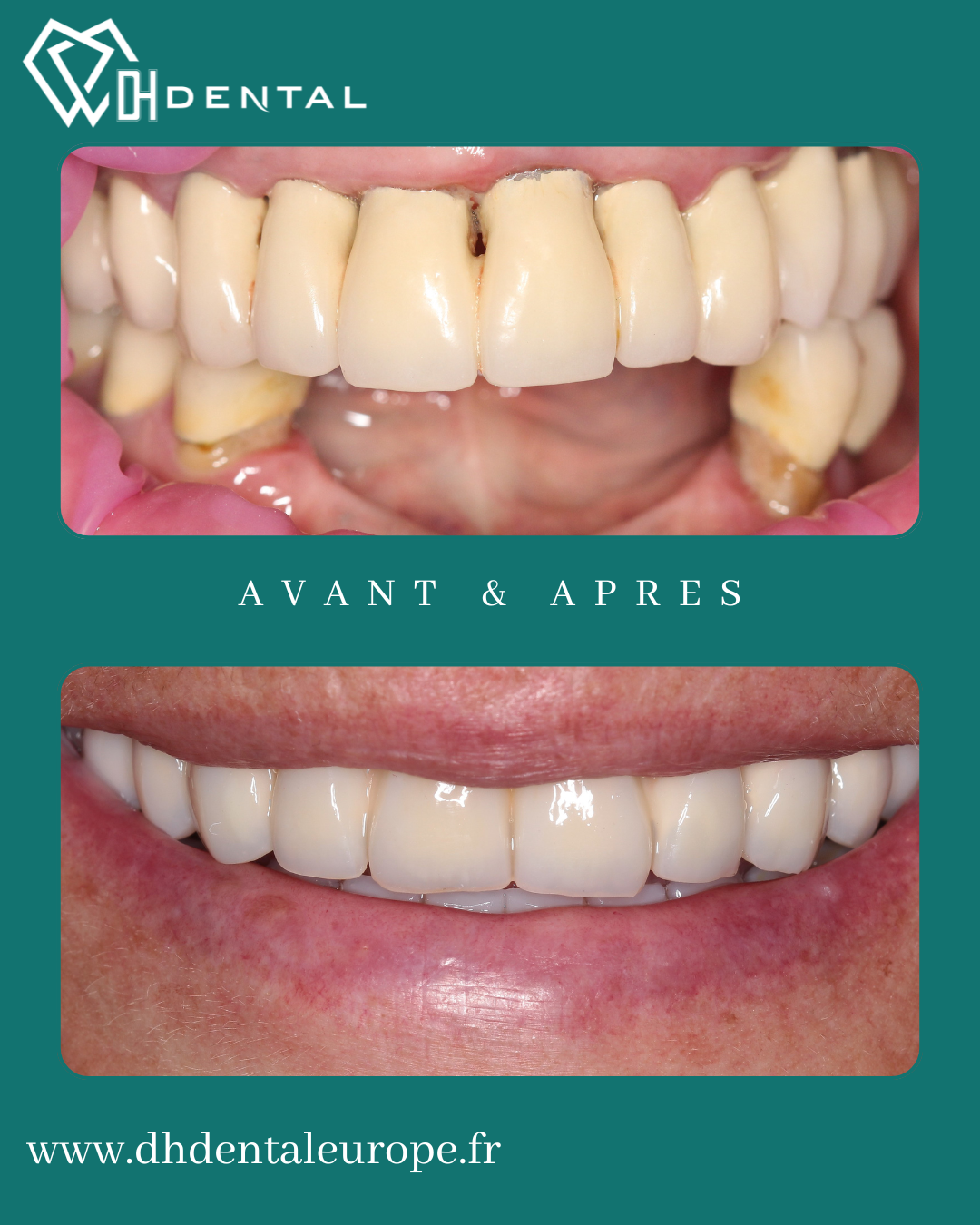 All-On-4 — DH Dental
