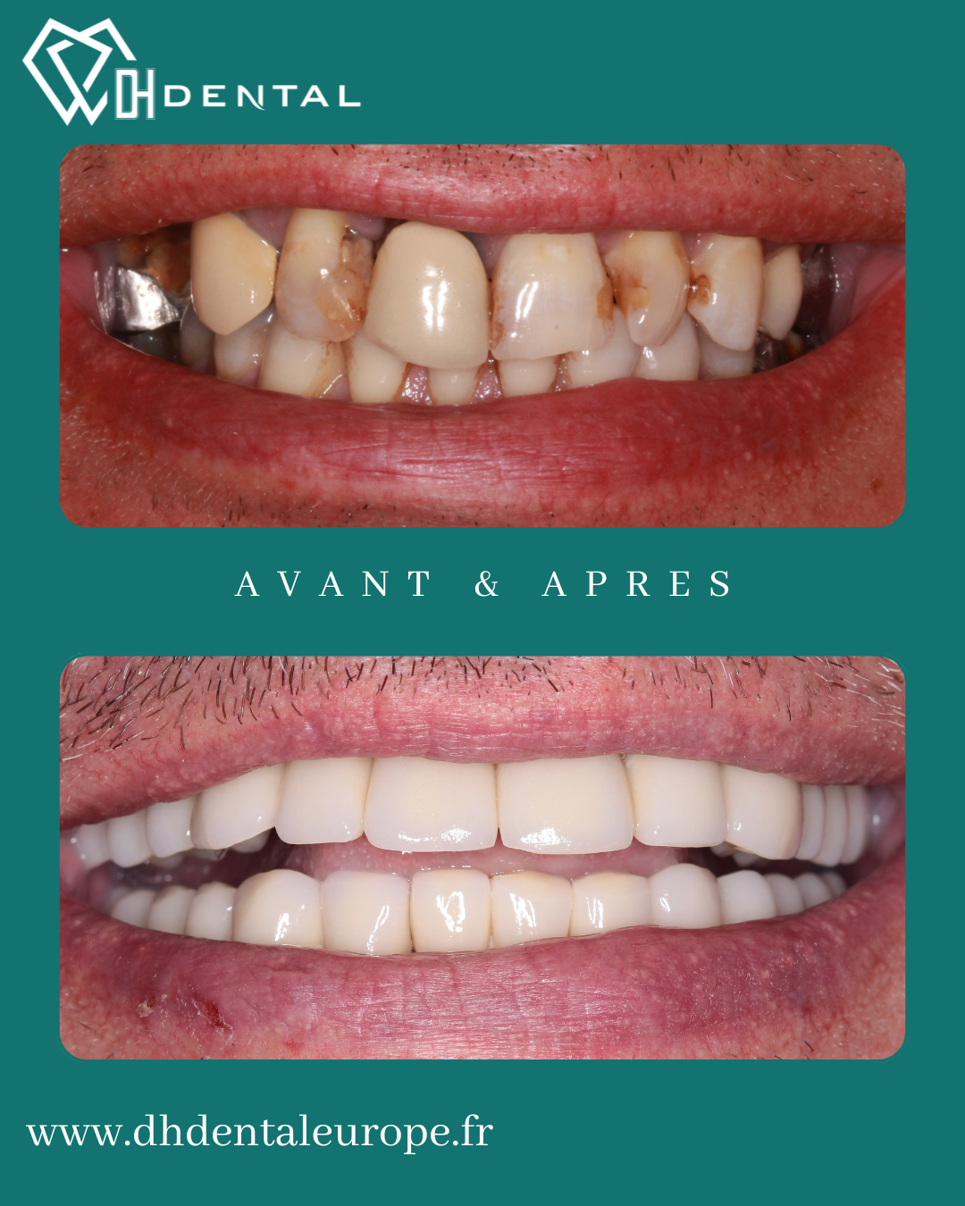 Couronnes Dentaires — DH Dental