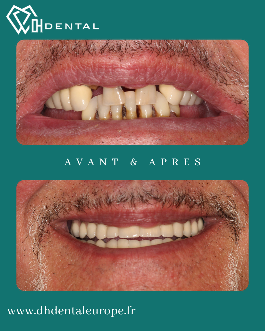 All-On-6 — DH Dental