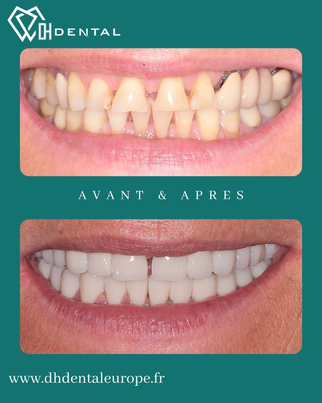 Couronnes Zircones — DH Dental