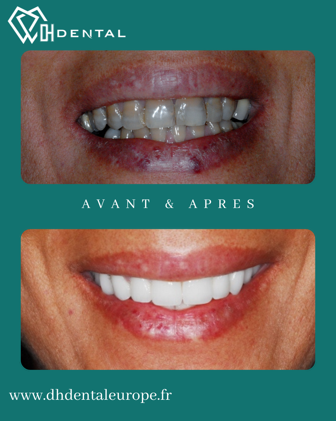Couronnes Zircones — DH Dental