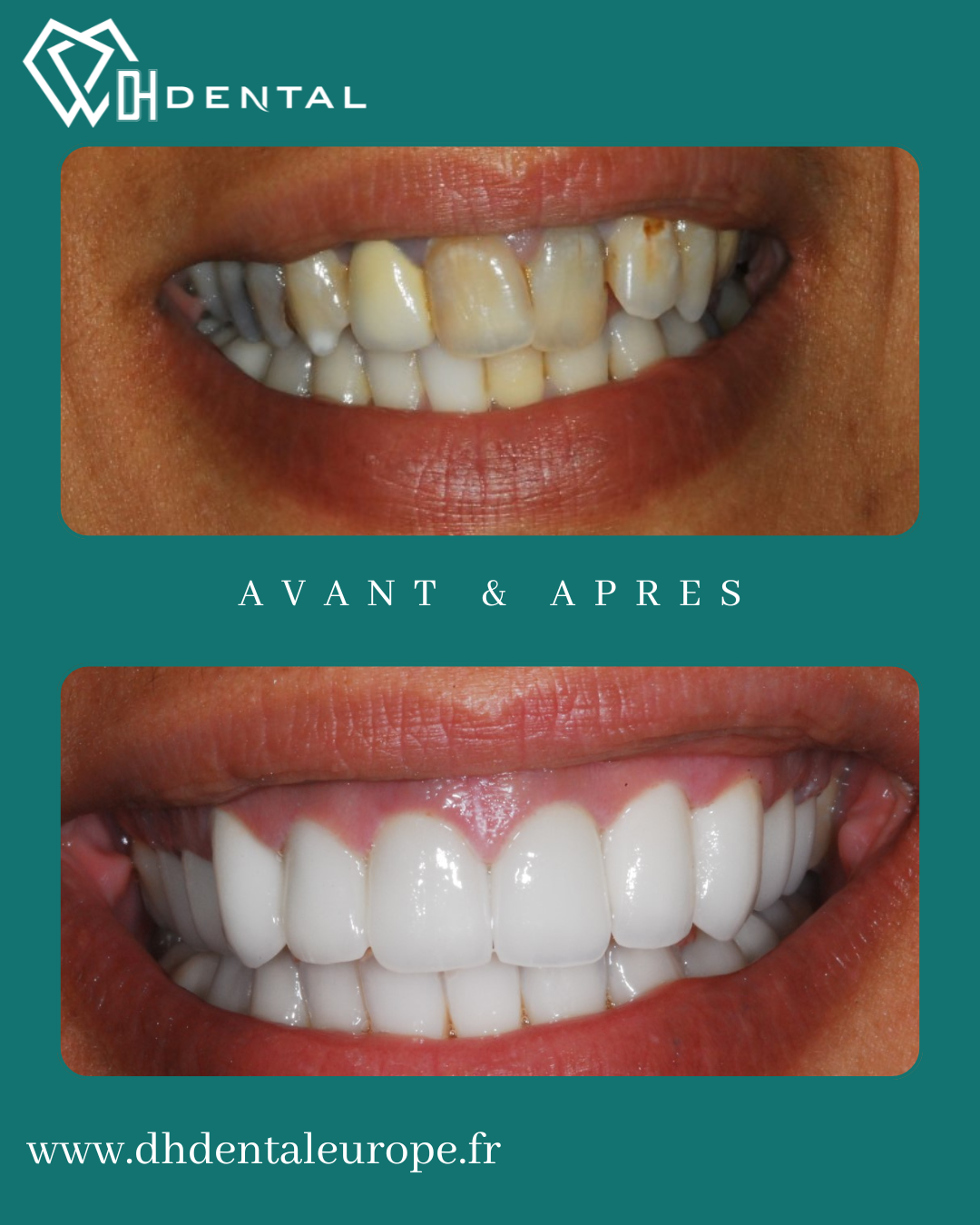 Couronnes Zircones — DH Dental