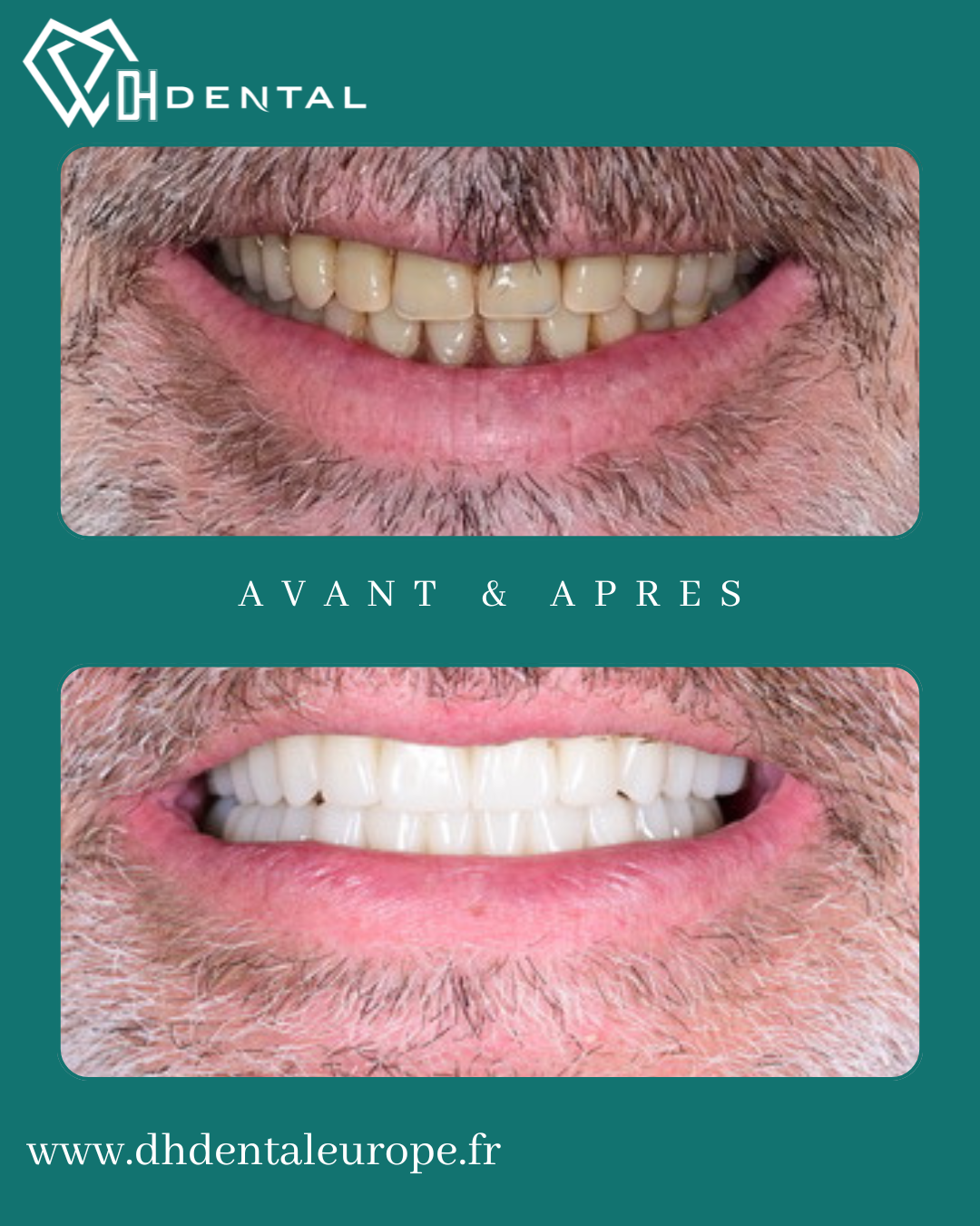 Couronnes Zircones — DH Dental