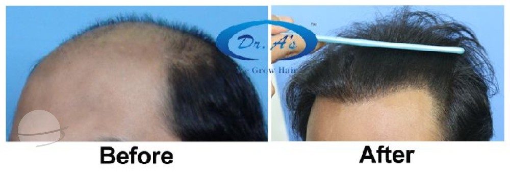 7196 grafts . 54 months update- Dr. A’s Clinic (3964 FUSE/fue grafts + 2893 beard grafts + 339 FUSE/fue grafts)