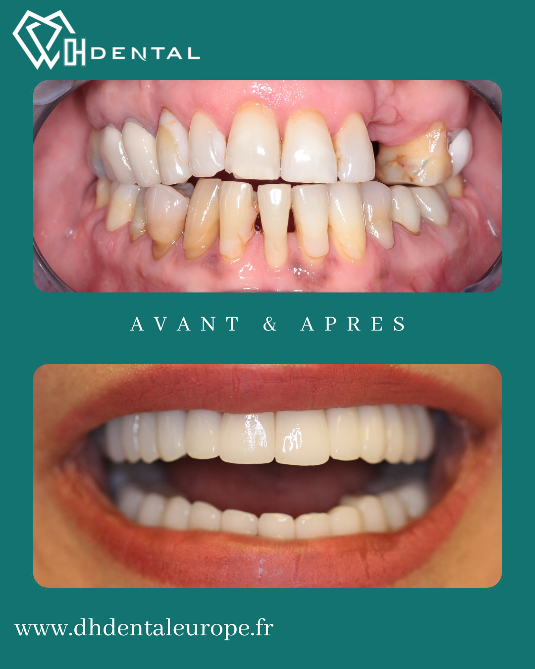 Couronnes Zircones — DH Dental