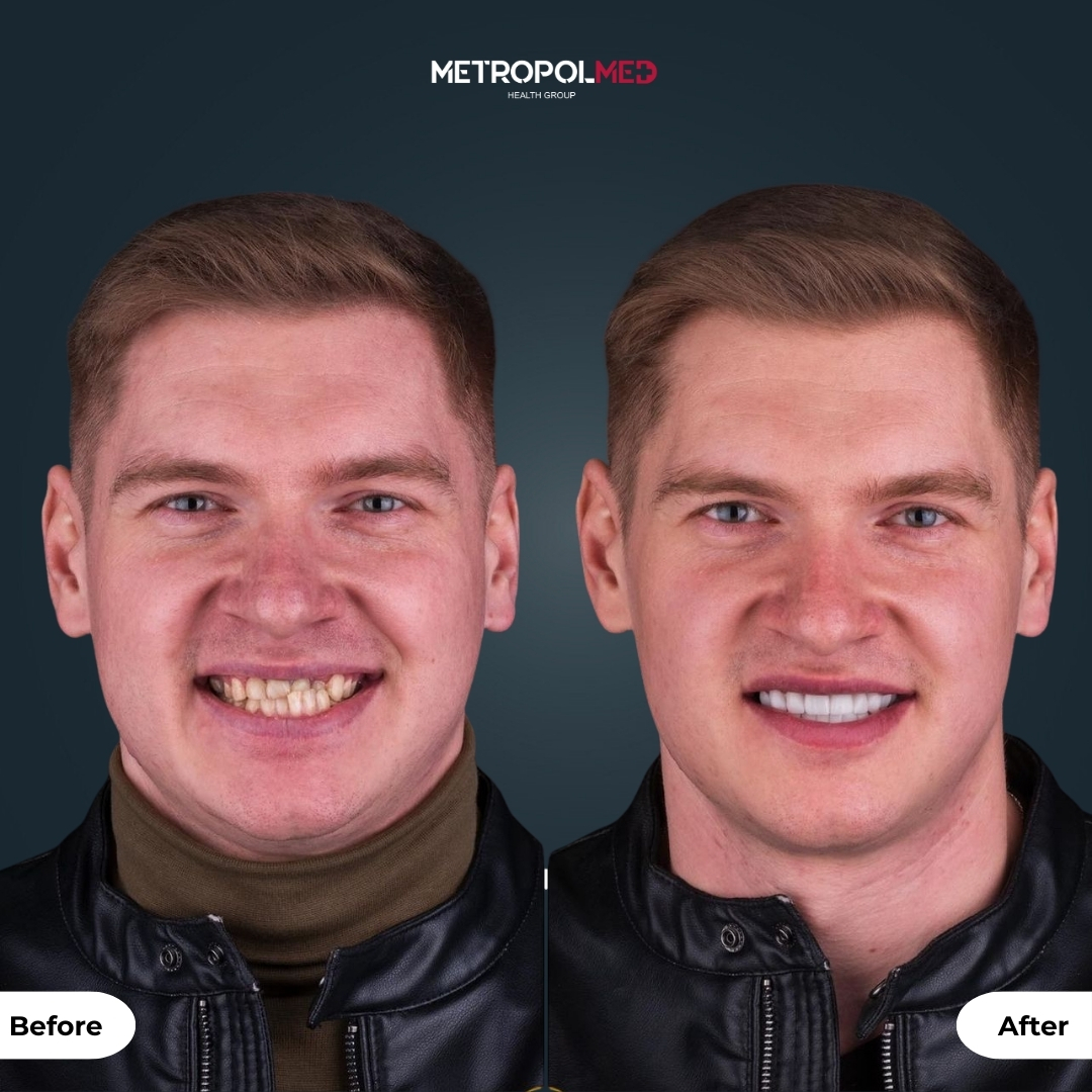 Facettes Dentaires — Metropolmed