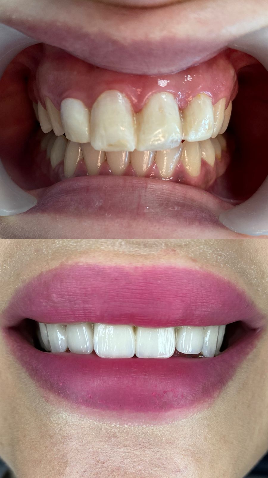 Facettes Dentaires — Dr Yahia Kochat Clinic