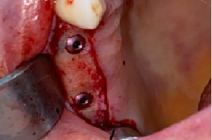 Implants Dentaires — Dr Yahia Kochat Clinic