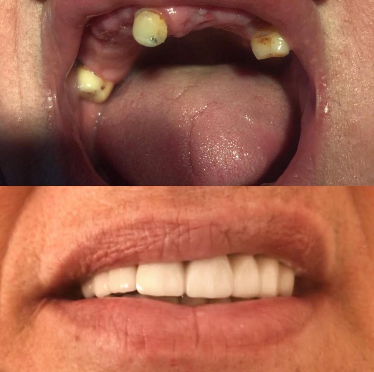 All-On-6 — Dr Yahia Kochat Clinic