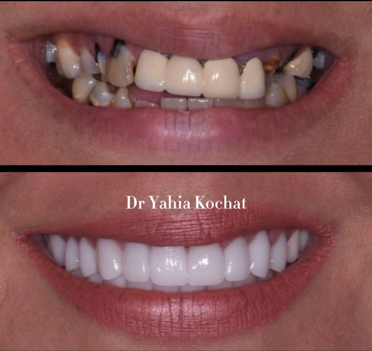 Reconstruction Totale — Dr Yahia Kochat Clinic