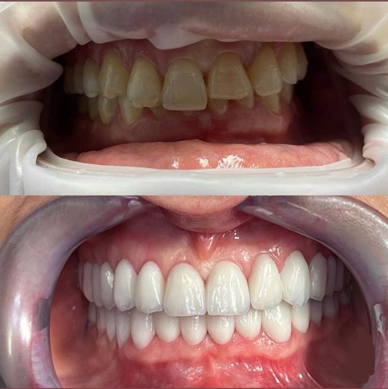 Hollywood Smile — Dr Yahia Kochat Clinic