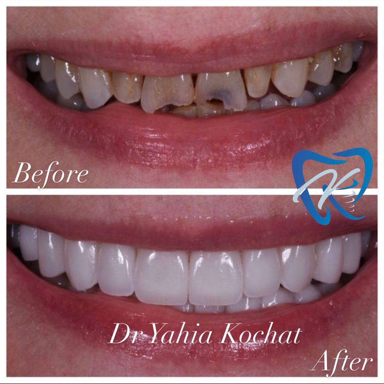 Pack 16 Facettes — Dr Yahia Kochat Clinic