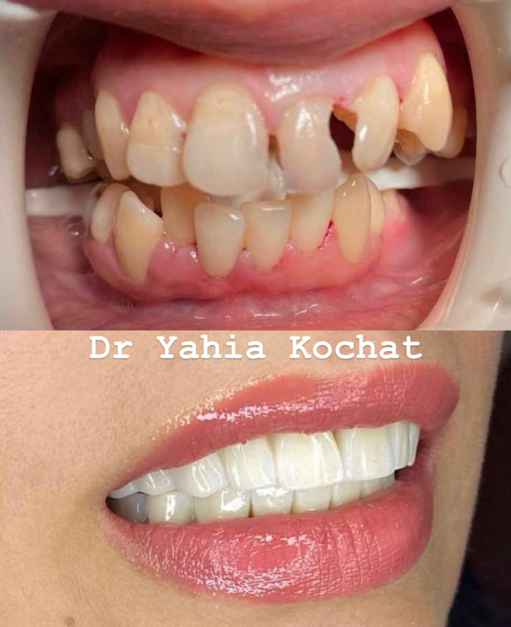 Pack 20 Couronnes — Dr Yahia Kochat Clinic