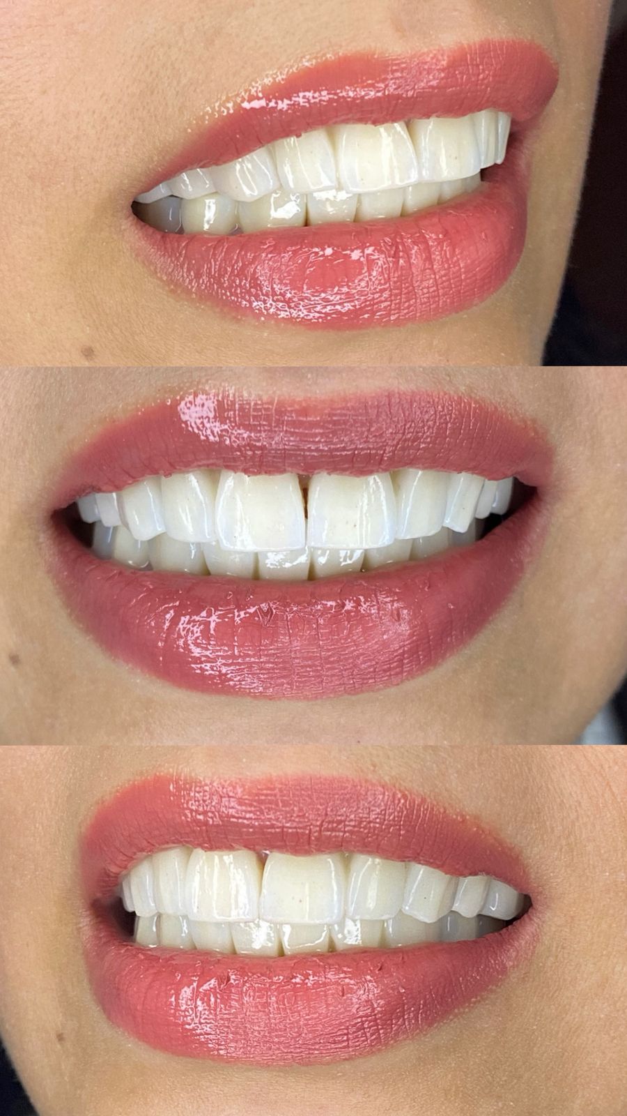 Pack 20 Facettes — Dr Yahia Kochat Clinic