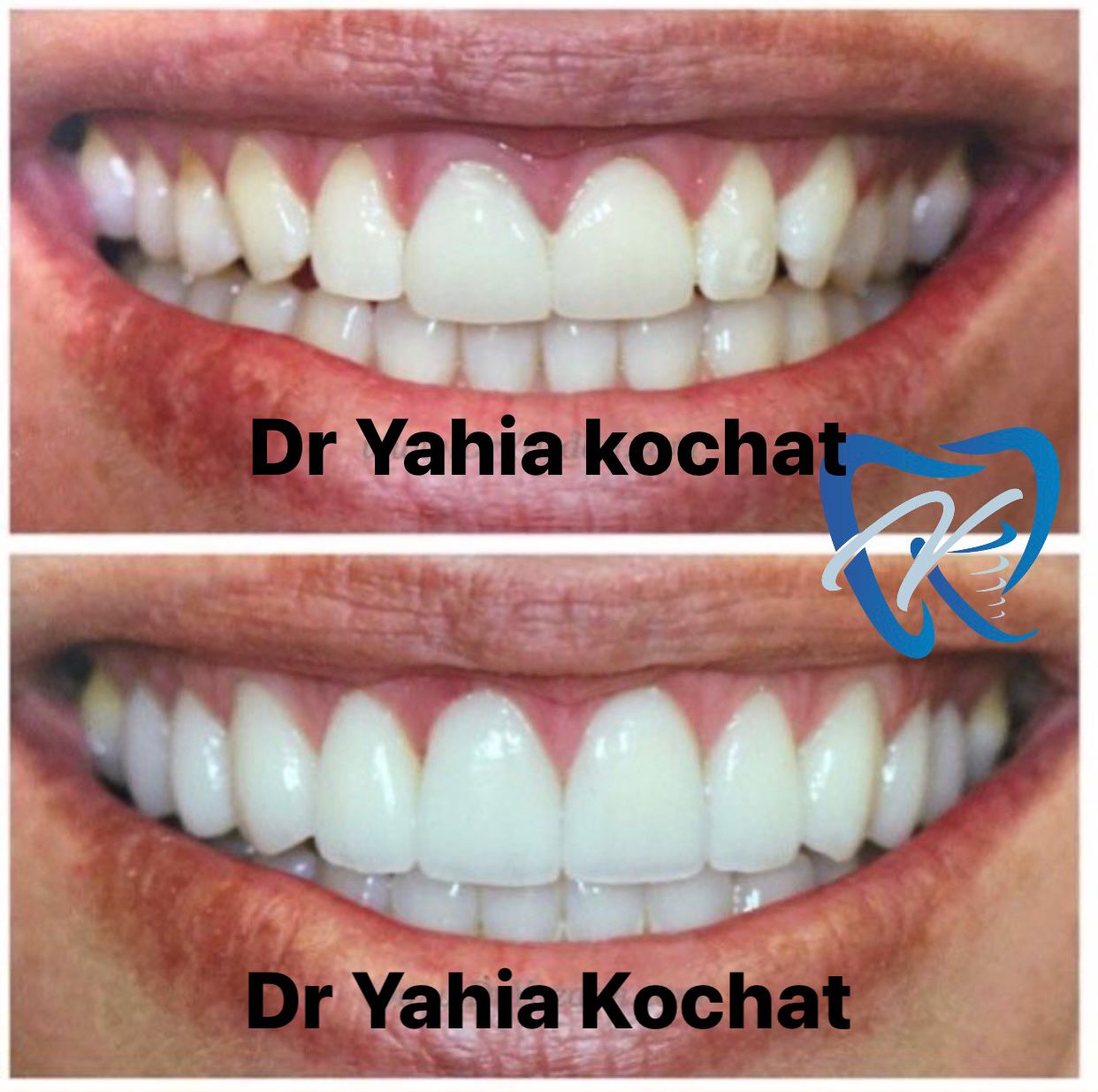 Pack 16 Couronnes — Dr Yahia Kochat Clinic