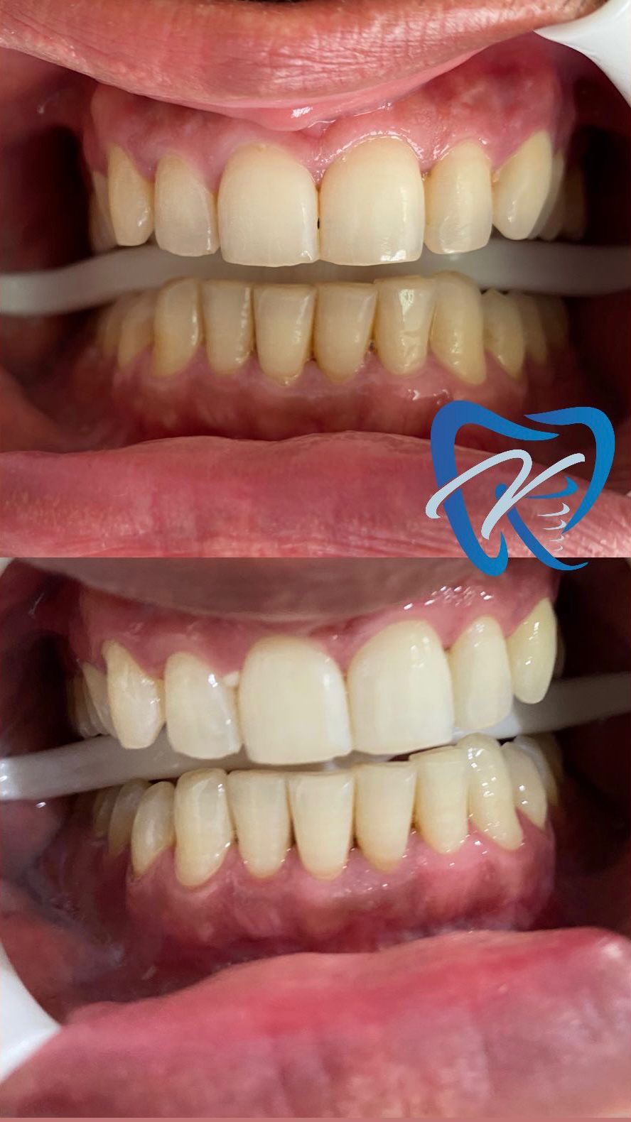 Blanchiment Dentaire — Dr Yahia Kochat Clinic