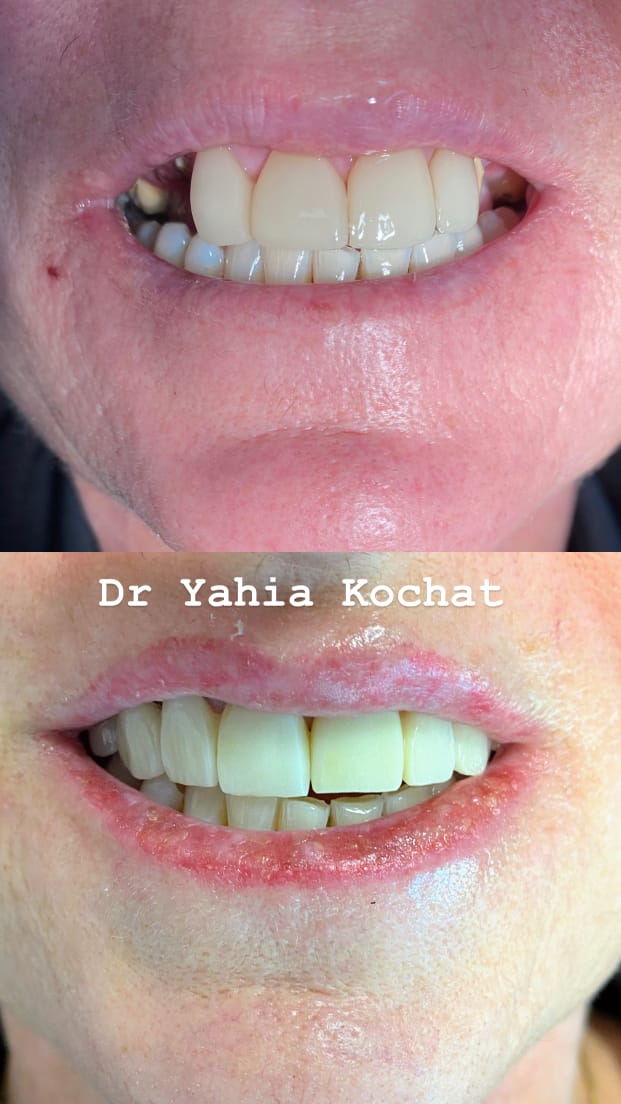 Couronnes Zircones — Dr Yahia Kochat Clinic