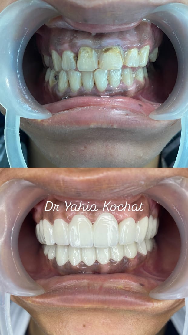 Pack 8 Couronnes — Dr Yahia Kochat Clinic