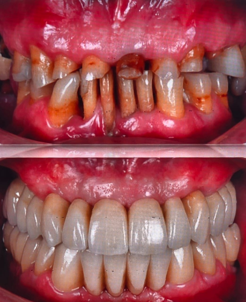 All-On-4 — Dr Yahia Kochat Clinic