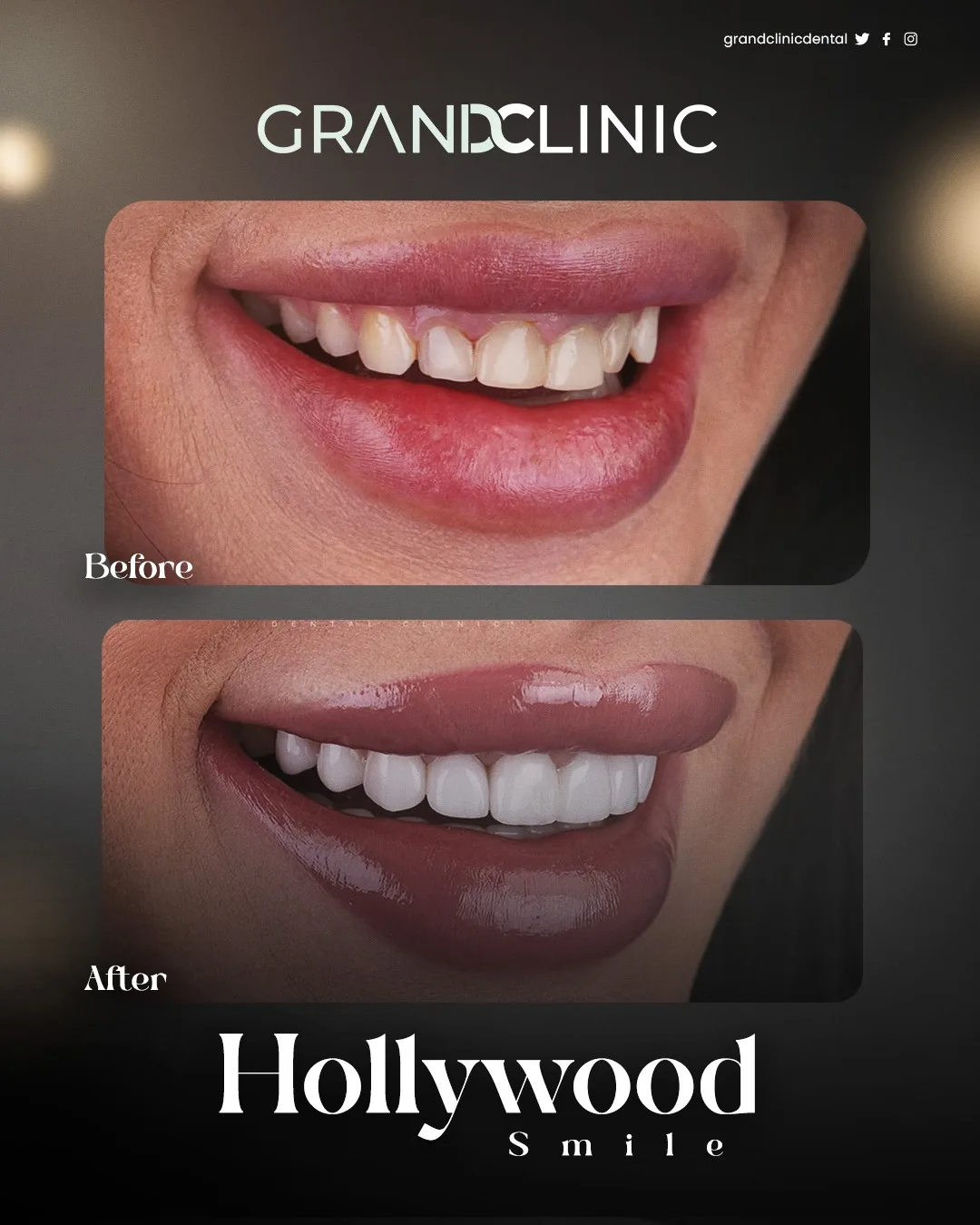 Blanchiment Dentaire — Grand Clinic