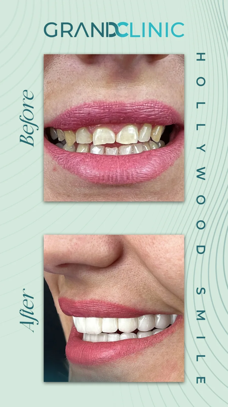 Couronnes Zircones — Grand Clinic