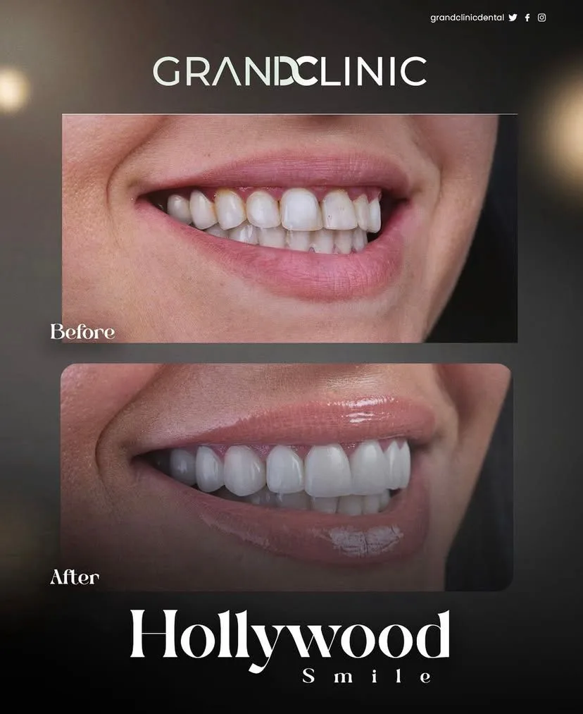 Couronnes Zircones — Grand Clinic