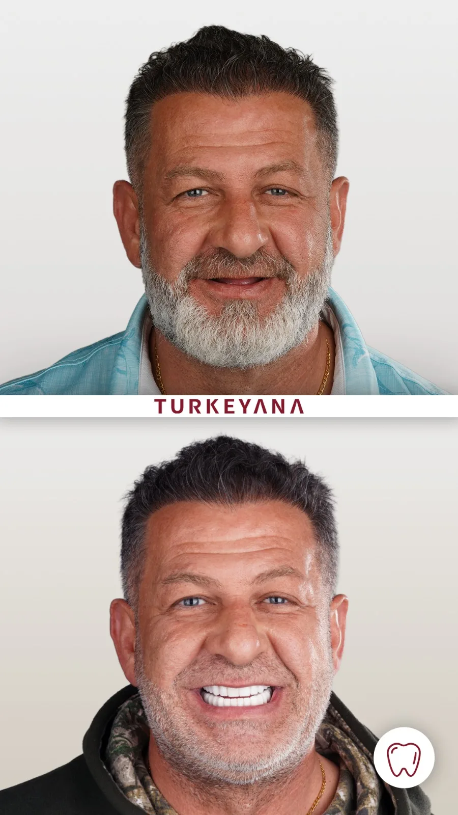 Facettes Dentaires — Turkeyana