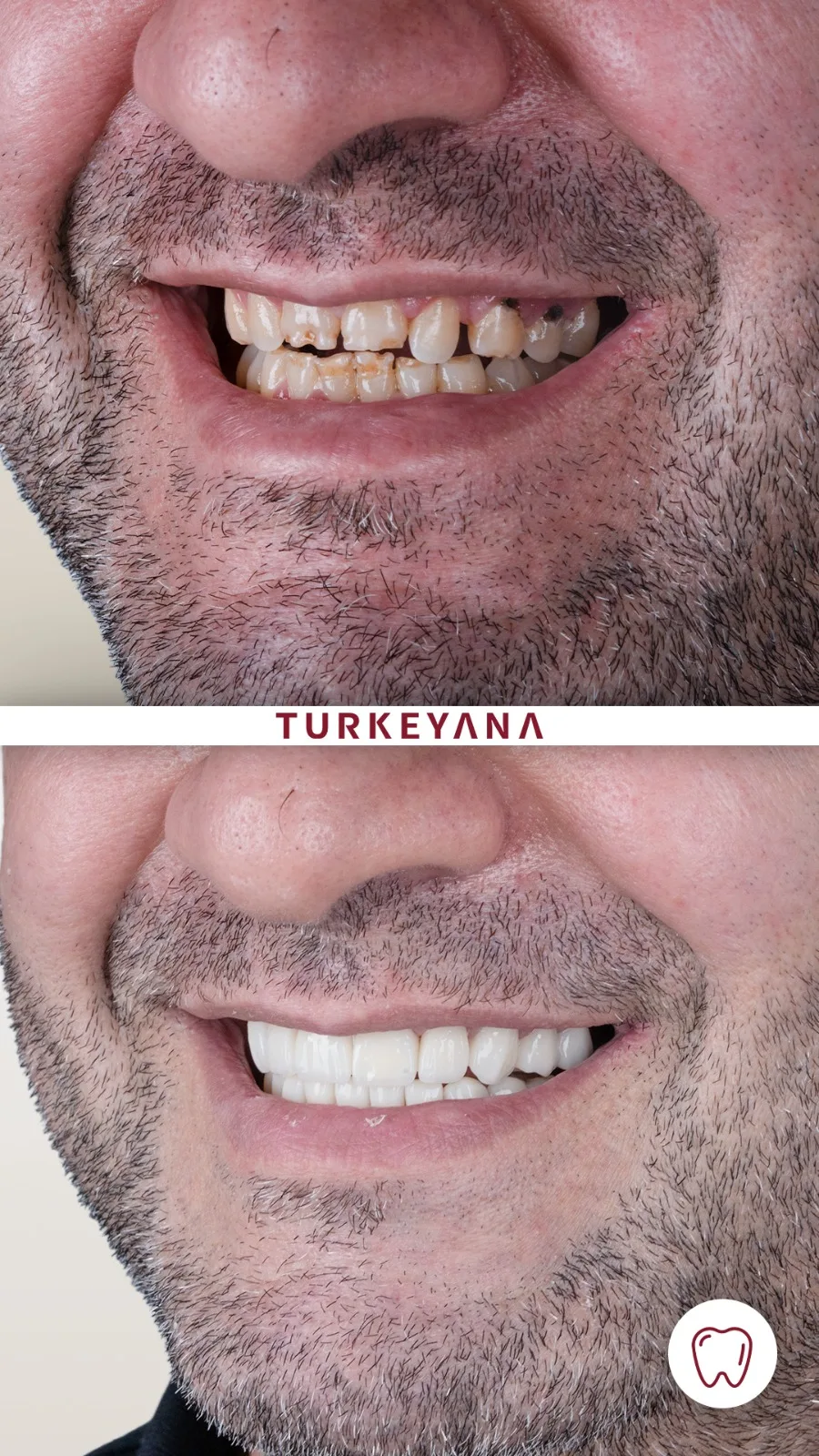 Couronnes Dentaires — Turkeyana