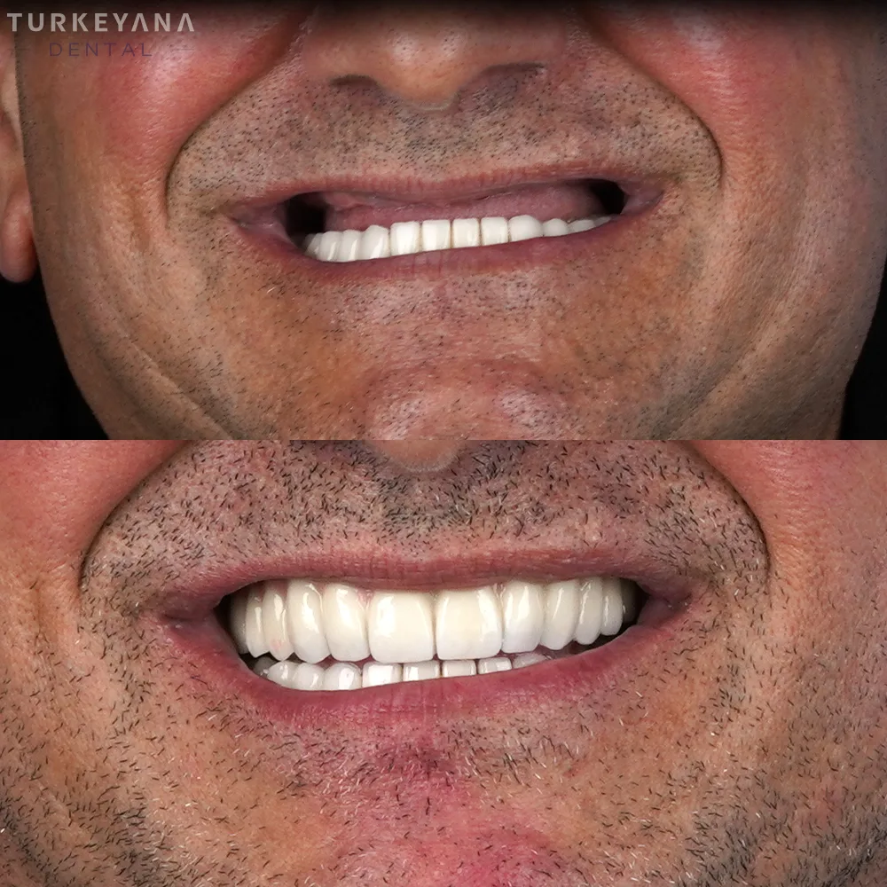 Implants Dentaires — Turkeyana