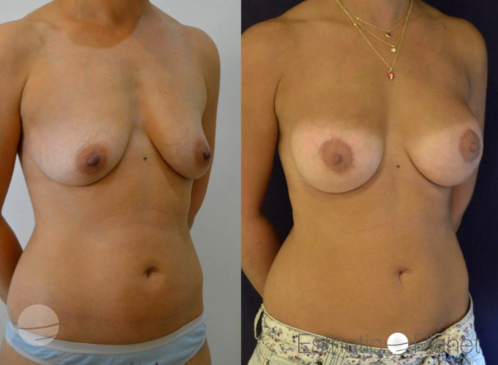 Lifting des seins, breast lift by Dr Ergin Er 